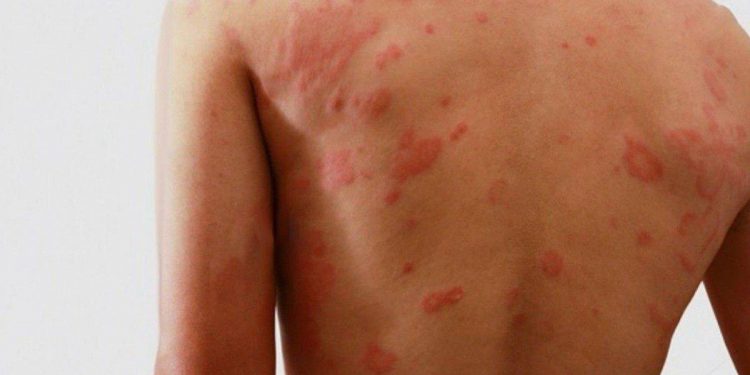 Duque de Caxias realiza ações de conscientização sobre a hanseníase