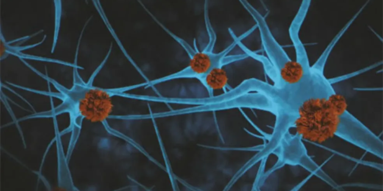 Droga retarda a progressão do Alzheimer em 60% para pacientes em estágios iniciais da doença